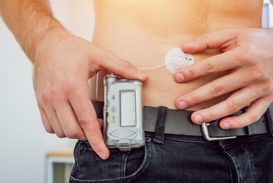 stock image of man wearing an insulin pump